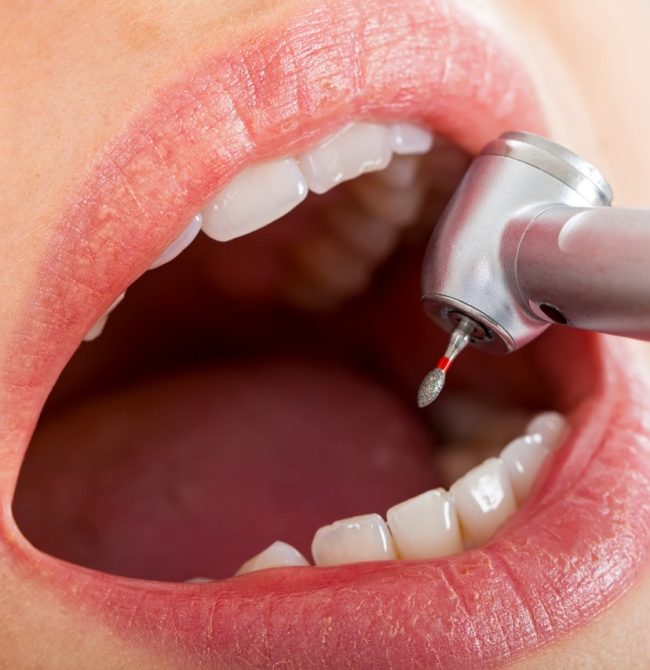 Close up picture of dental drill in young female patient's mouth